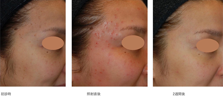 施術例：脂漏性角化症